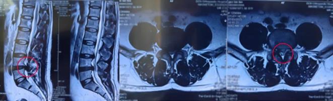 骨科科普|腰椎間盤突出疼痛半年，椎間孔鏡技術一朝解決